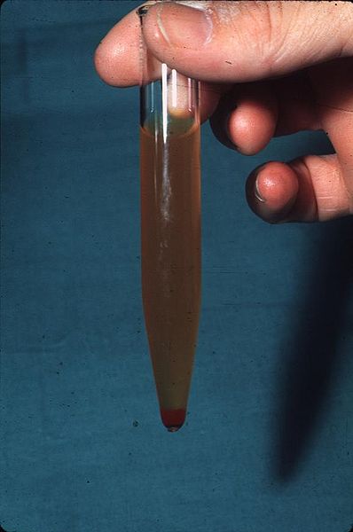 Hematuria