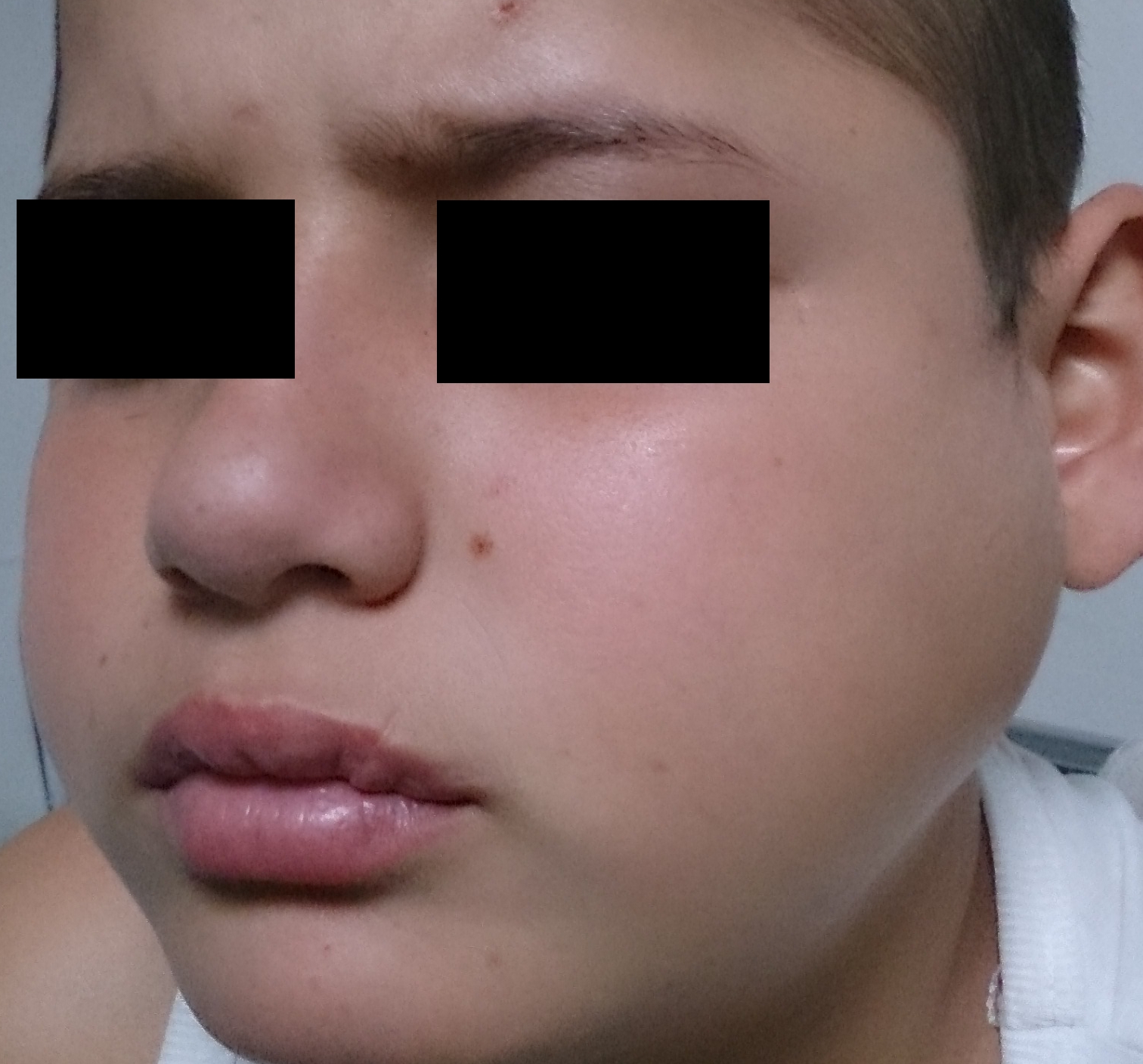 Parotiditis Parotitis Mumps